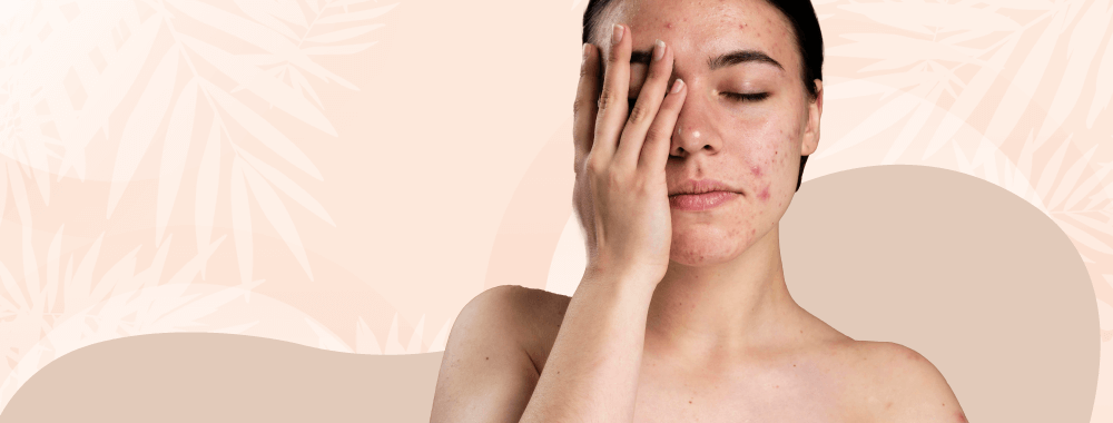 Como afecta el estrés a nuestra piel