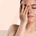 Como afecta el estrés a nuestra piel